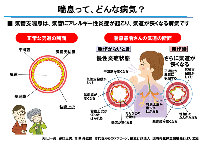 気管支喘息の定義